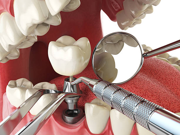 Best Emergency Root Canal Treatment in St Augustine South, FL